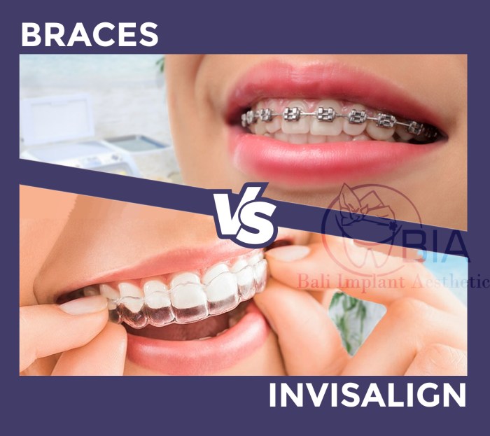 perbedaan invisalign dan aligner